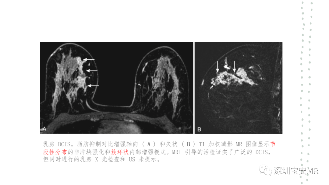 影像PPT - 【PPT】乳腺磁共振科普-28