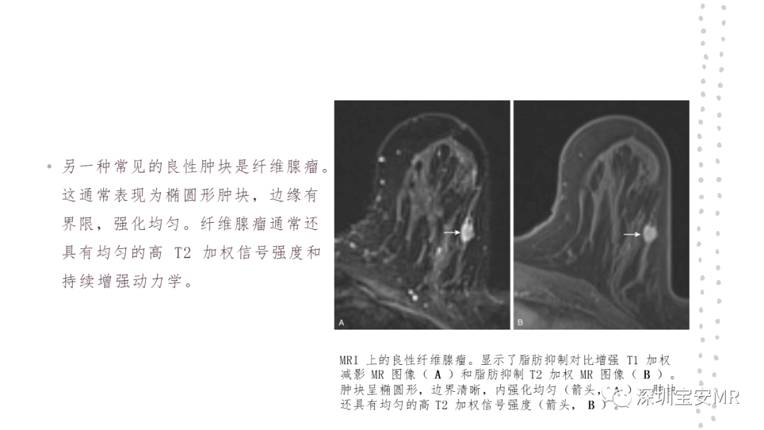 影像PPT - 【PPT】乳腺磁共振科普-24