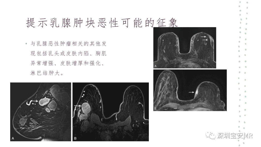 影像PPT - 【PPT】乳腺磁共振科普-26