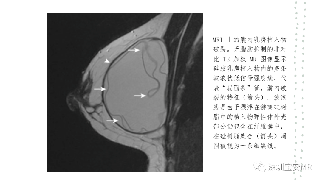 影像PPT - 【PPT】乳腺磁共振科普-36