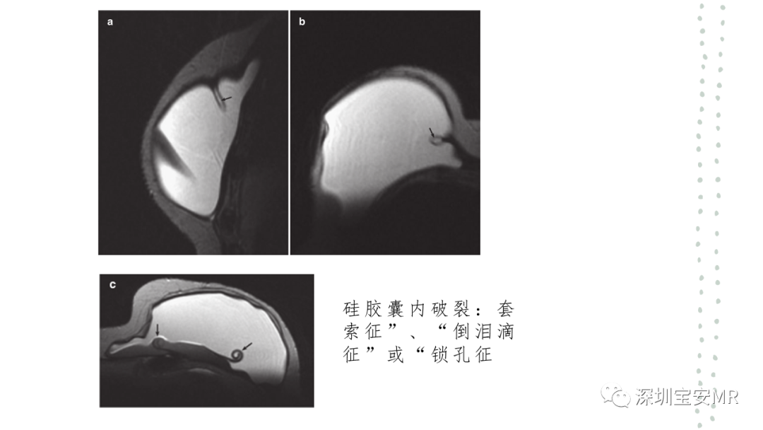 影像PPT - 【PPT】乳腺磁共振科普-37