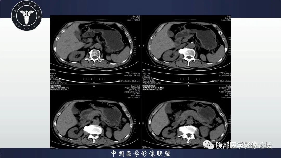 影像PPT - 【病例】肾脏血管平滑肌脂肪瘤AML一例CT-3