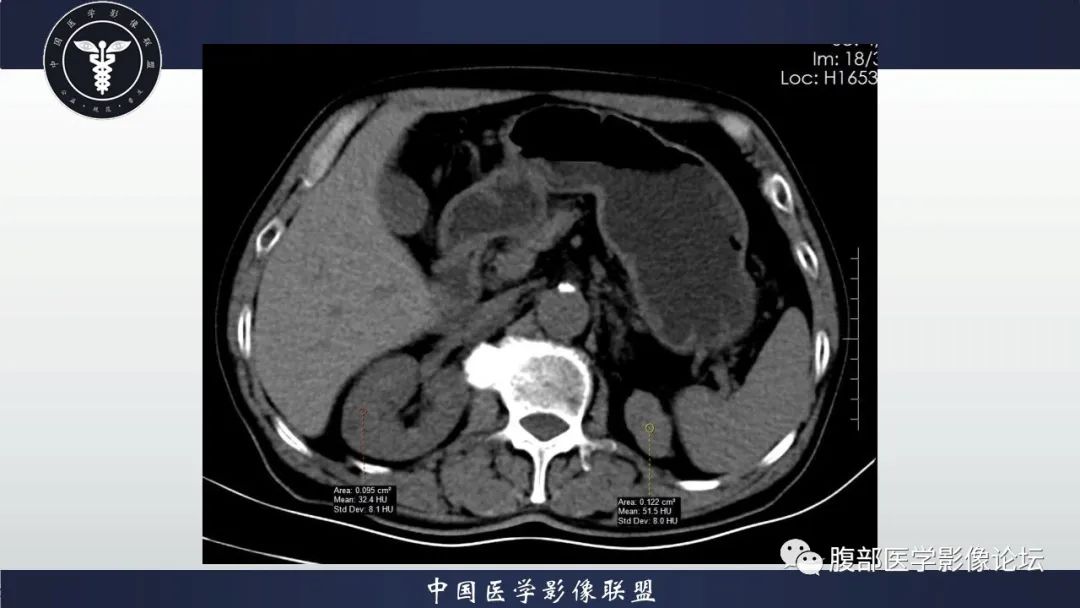 影像PPT - 【病例】肾脏血管平滑肌脂肪瘤AML一例CT-4
