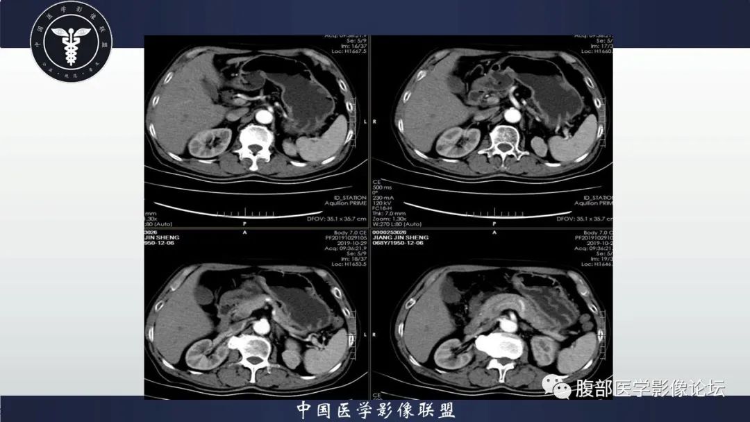 影像PPT - 【病例】肾脏血管平滑肌脂肪瘤AML一例CT-5