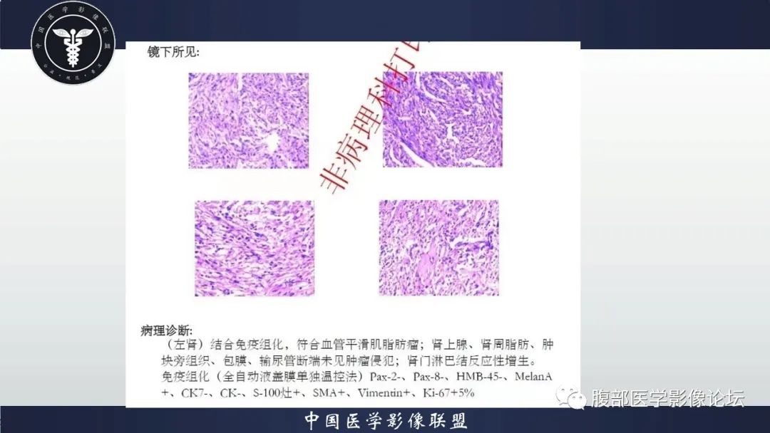 影像PPT - 【病例】肾脏血管平滑肌脂肪瘤AML一例CT-9