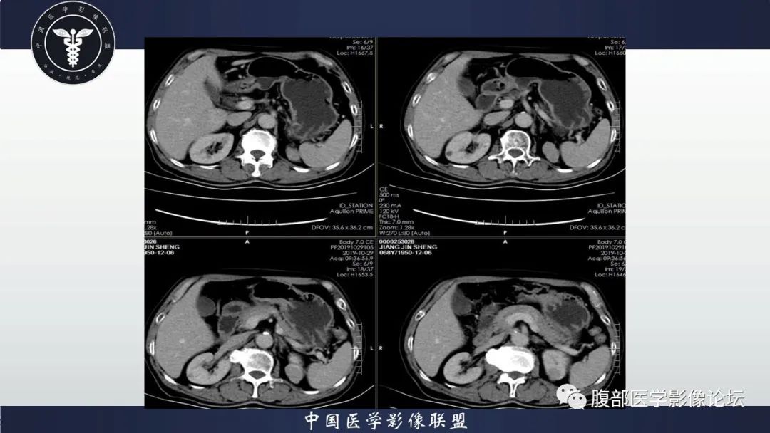 影像PPT - 【病例】肾脏血管平滑肌脂肪瘤AML一例CT-6