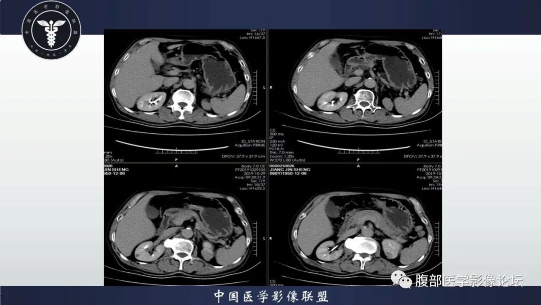 影像PPT - 【病例】肾脏血管平滑肌脂肪瘤AML一例CT-7