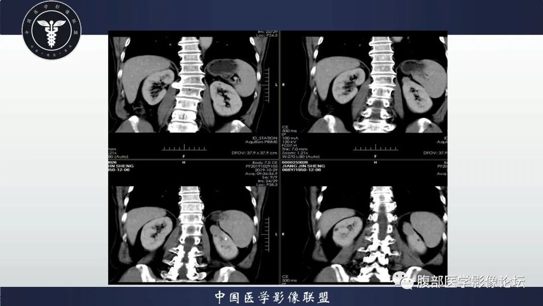 影像PPT - 【病例】肾脏血管平滑肌脂肪瘤AML一例CT-8
