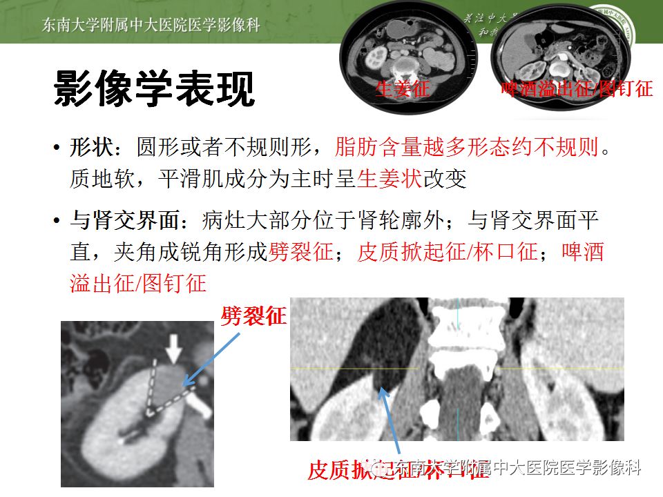 影像PPT - 【病例】肾脏血管平滑肌脂肪瘤AML一例CT-14
