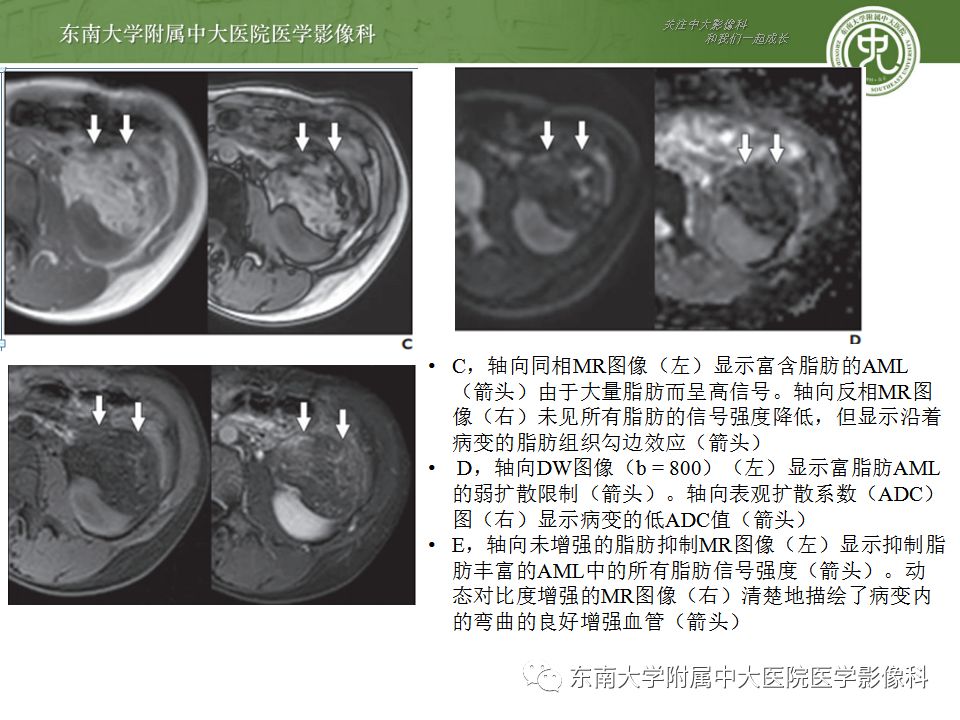 影像PPT - 【病例】肾脏血管平滑肌脂肪瘤AML一例CT-18