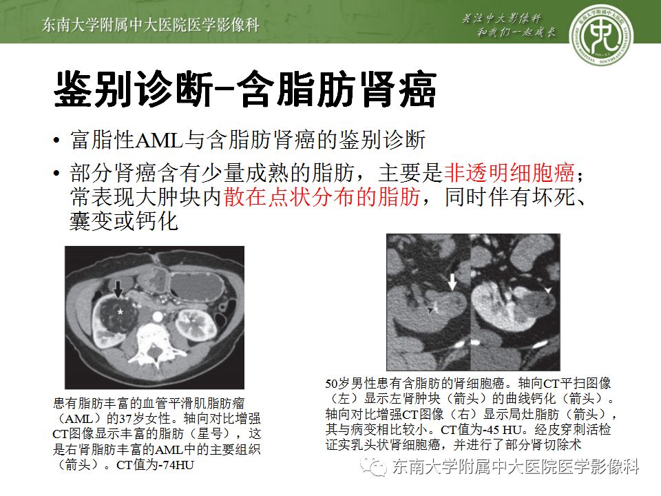 影像PPT - 【病例】肾脏血管平滑肌脂肪瘤AML一例CT-21