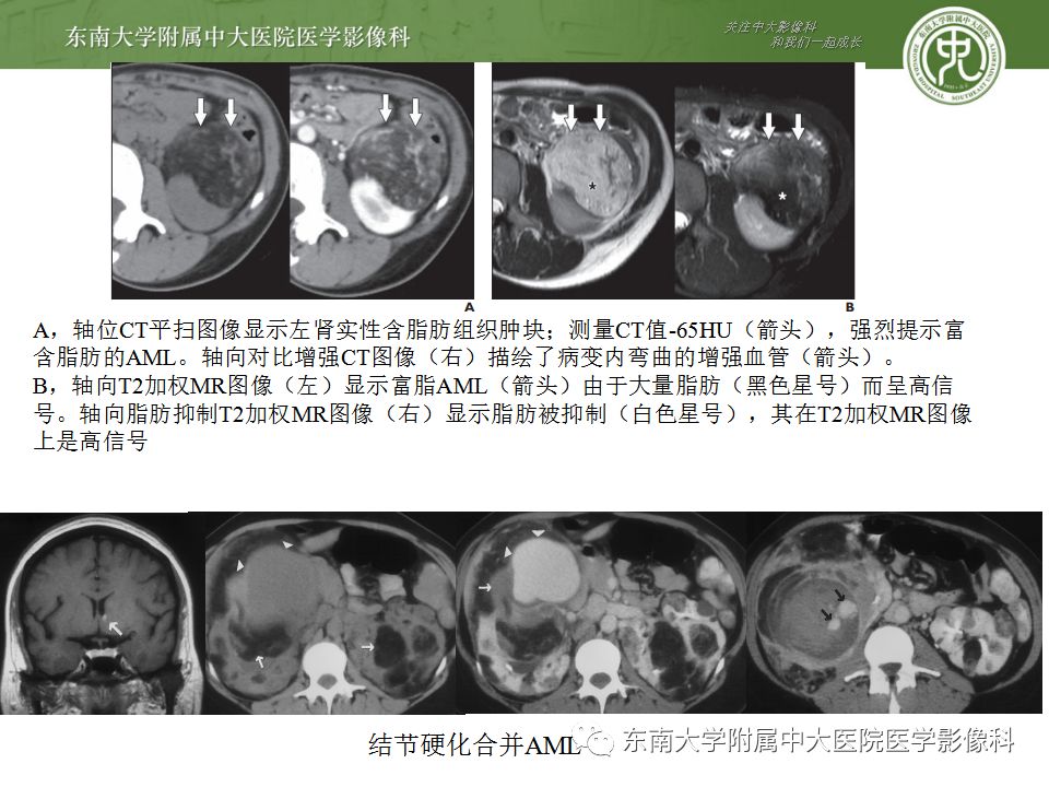 影像PPT - 【病例】肾脏血管平滑肌脂肪瘤AML一例CT-17