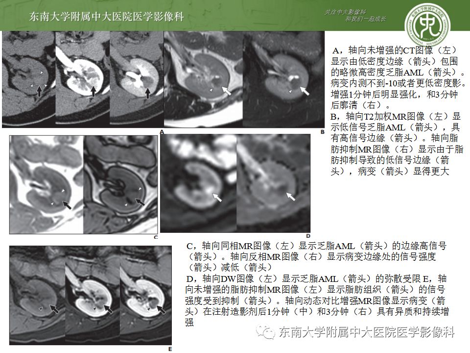 影像PPT - 【病例】肾脏血管平滑肌脂肪瘤AML一例CT-19