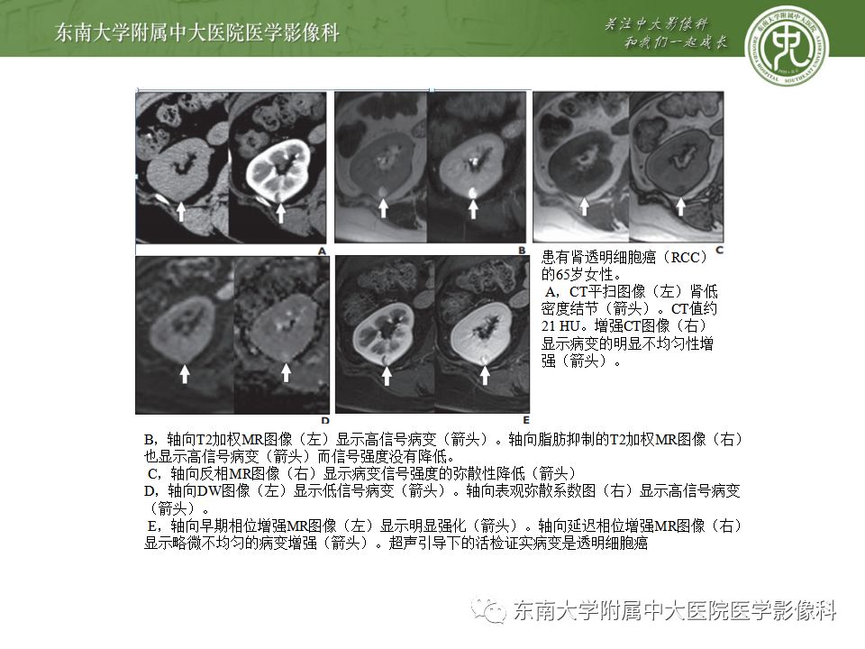 影像PPT - 【病例】肾脏血管平滑肌脂肪瘤AML一例CT-23