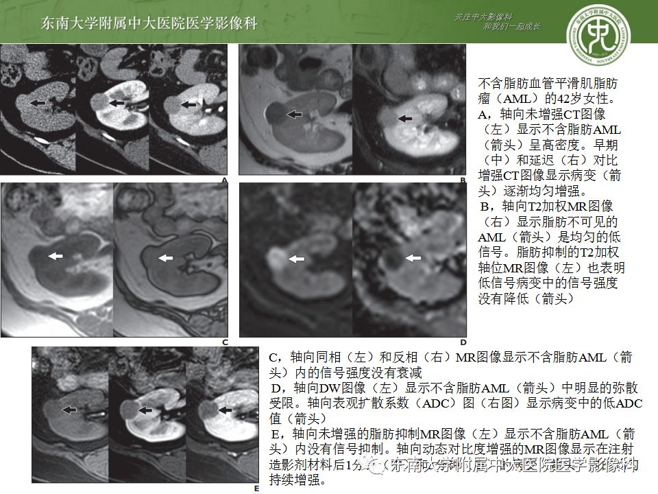 影像PPT - 【病例】肾脏血管平滑肌脂肪瘤AML一例CT-20