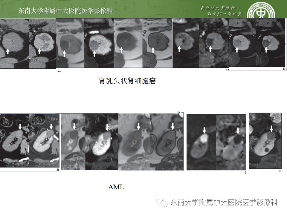 影像PPT - 【病例】肾脏血管平滑肌脂肪瘤AML一例CT-25