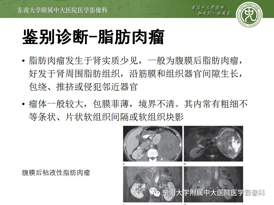 影像PPT - 【病例】肾脏血管平滑肌脂肪瘤AML一例CT-26