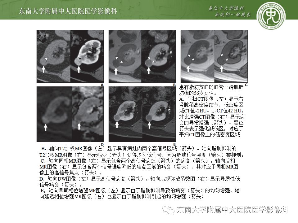 影像PPT - 【病例】肾脏血管平滑肌脂肪瘤AML一例CT-24