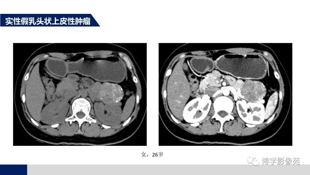 影像PPT - 【PPT】胰腺相关疾病-17