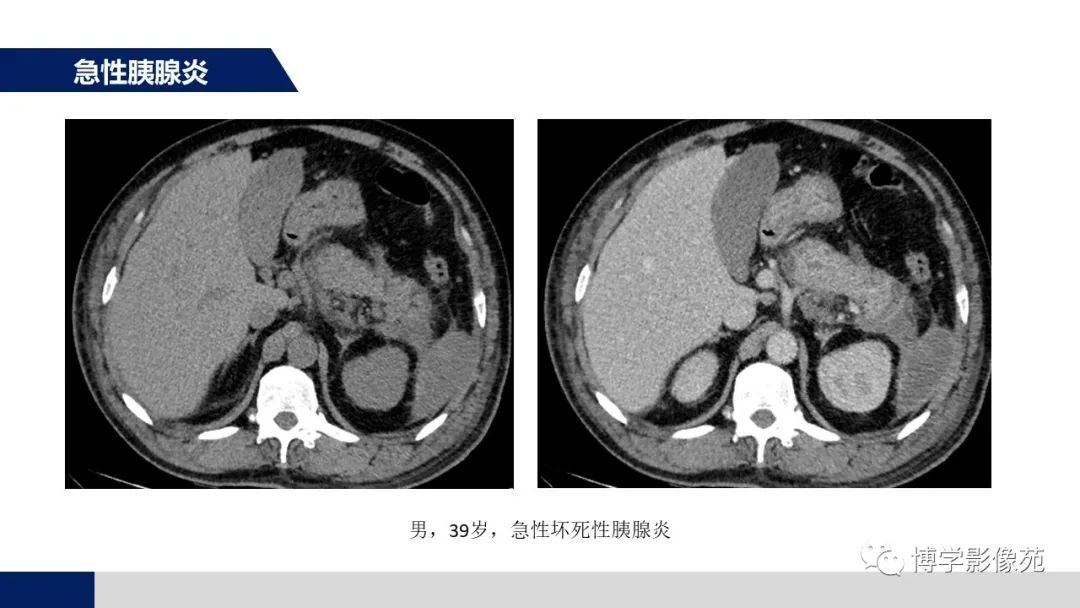 影像PPT - 【PPT】胰腺相关疾病-26