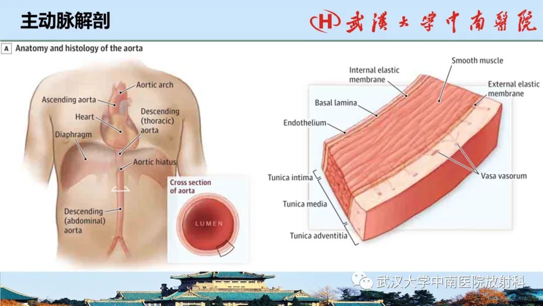 影像PPT - 【PPT】主动脉壁内血肿和穿透性溃疡的影像学诊断-5