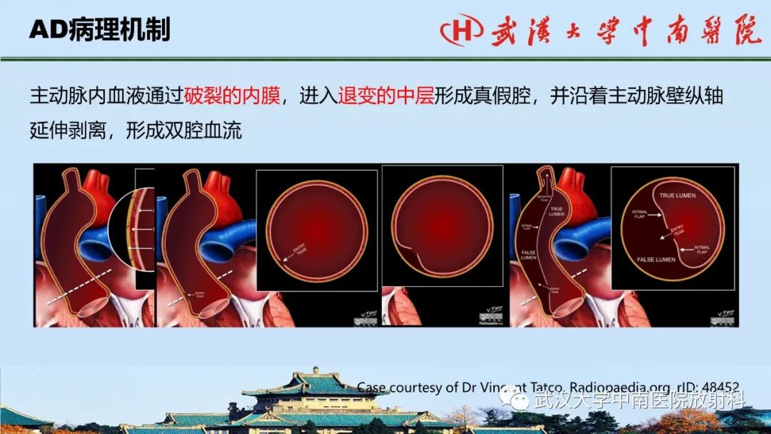影像PPT - 【PPT】主动脉壁内血肿和穿透性溃疡的影像学诊断-8