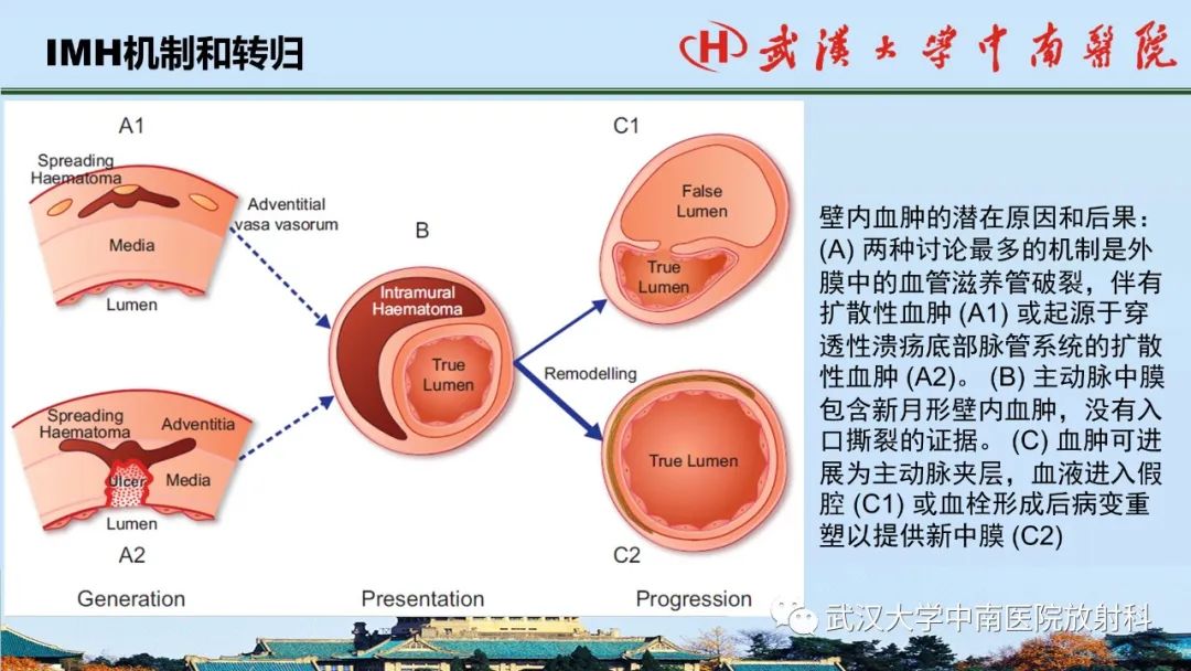 影像PPT - 【PPT】主动脉壁内血肿和穿透性溃疡的影像学诊断-10