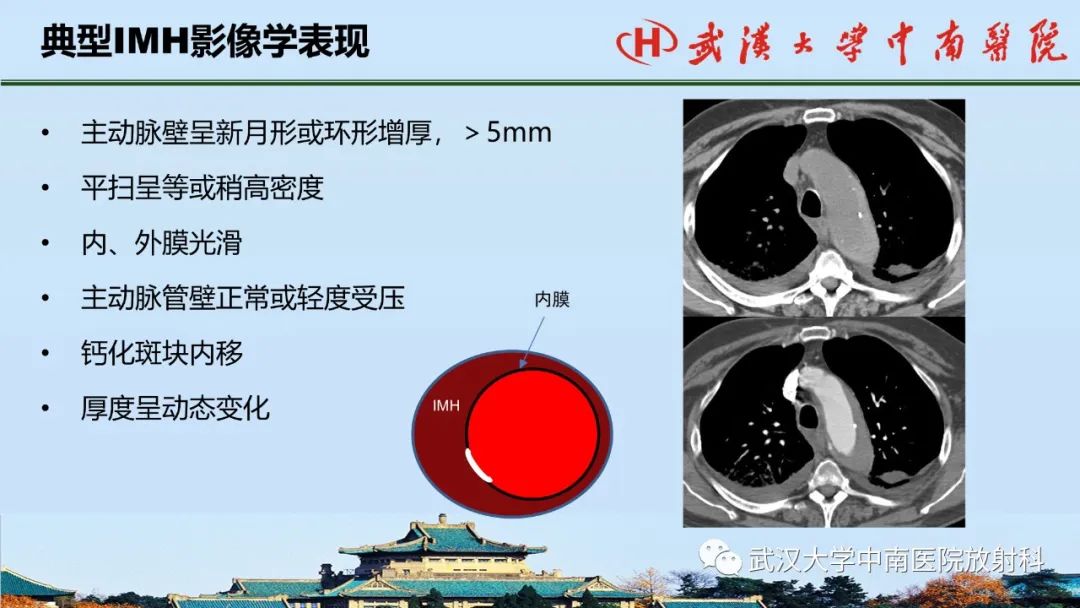 影像PPT - 【PPT】主动脉壁内血肿和穿透性溃疡的影像学诊断-11