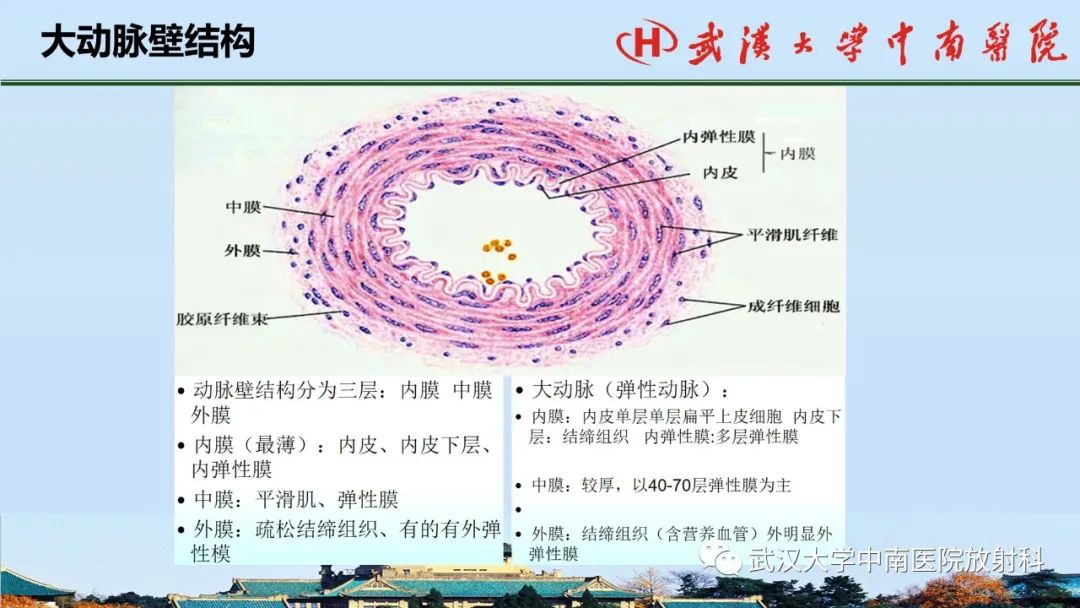 影像PPT - 【PPT】主动脉壁内血肿和穿透性溃疡的影像学诊断-6