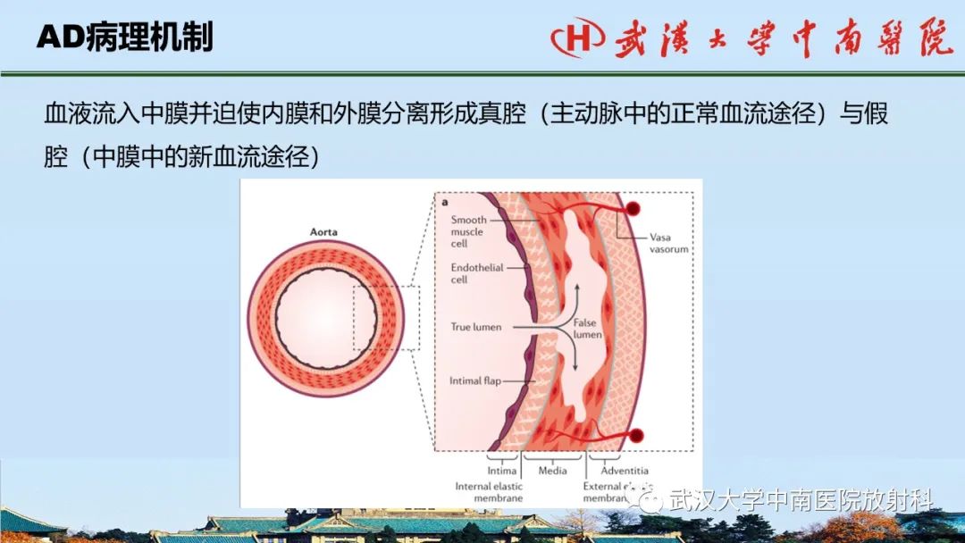 影像PPT - 【PPT】主动脉壁内血肿和穿透性溃疡的影像学诊断-7