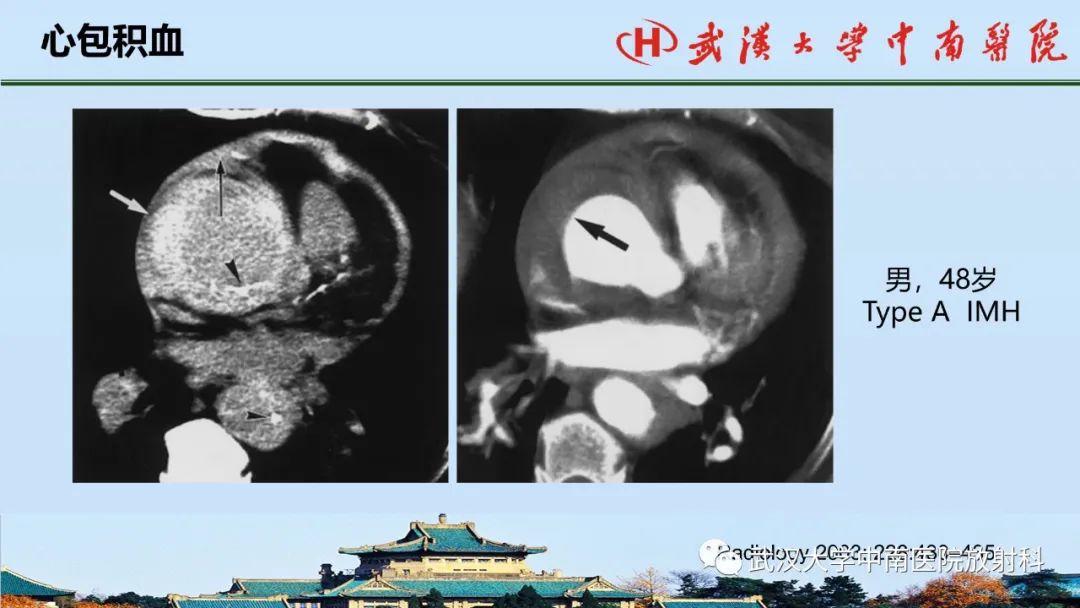 影像PPT - 【PPT】主动脉壁内血肿和穿透性溃疡的影像学诊断-15