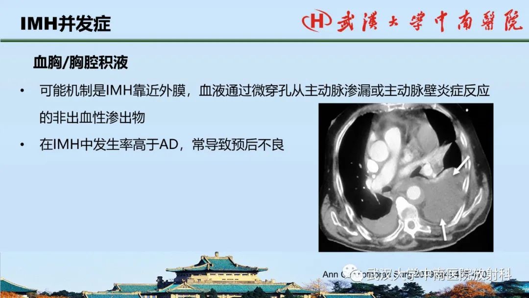 影像PPT - 【PPT】主动脉壁内血肿和穿透性溃疡的影像学诊断-16