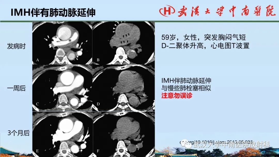 影像PPT - 【PPT】主动脉壁内血肿和穿透性溃疡的影像学诊断-17
