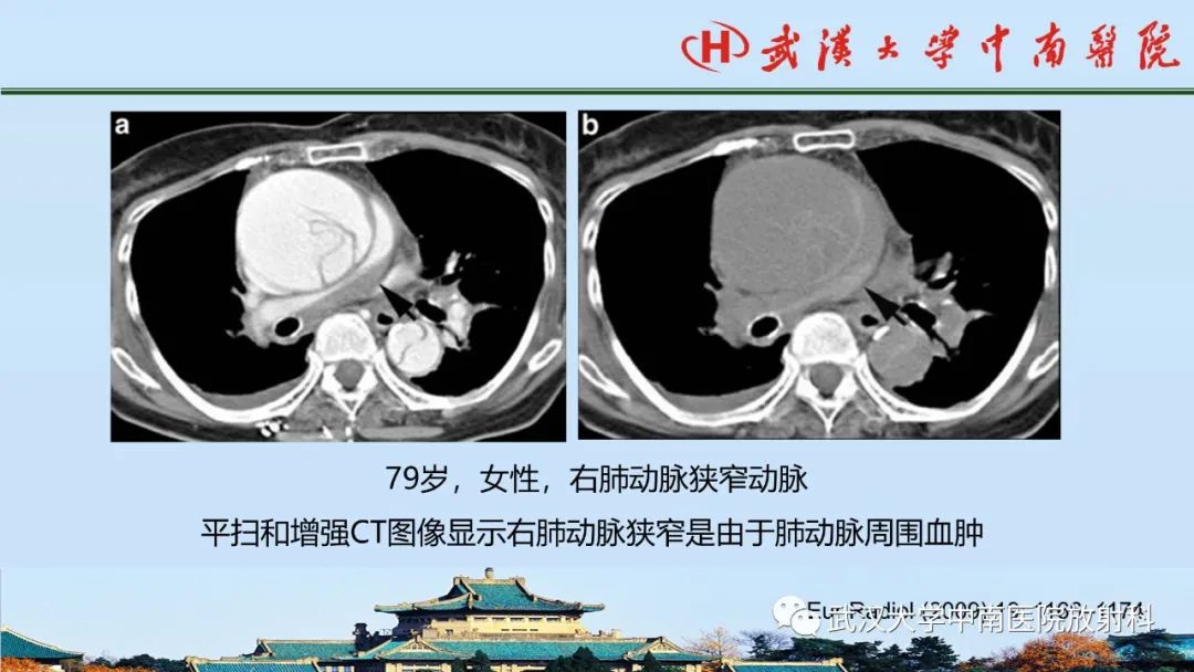 影像PPT - 【PPT】主动脉壁内血肿和穿透性溃疡的影像学诊断-18