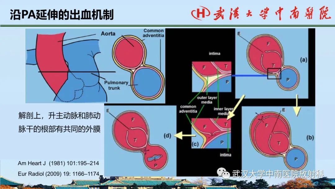 影像PPT - 【PPT】主动脉壁内血肿和穿透性溃疡的影像学诊断-19