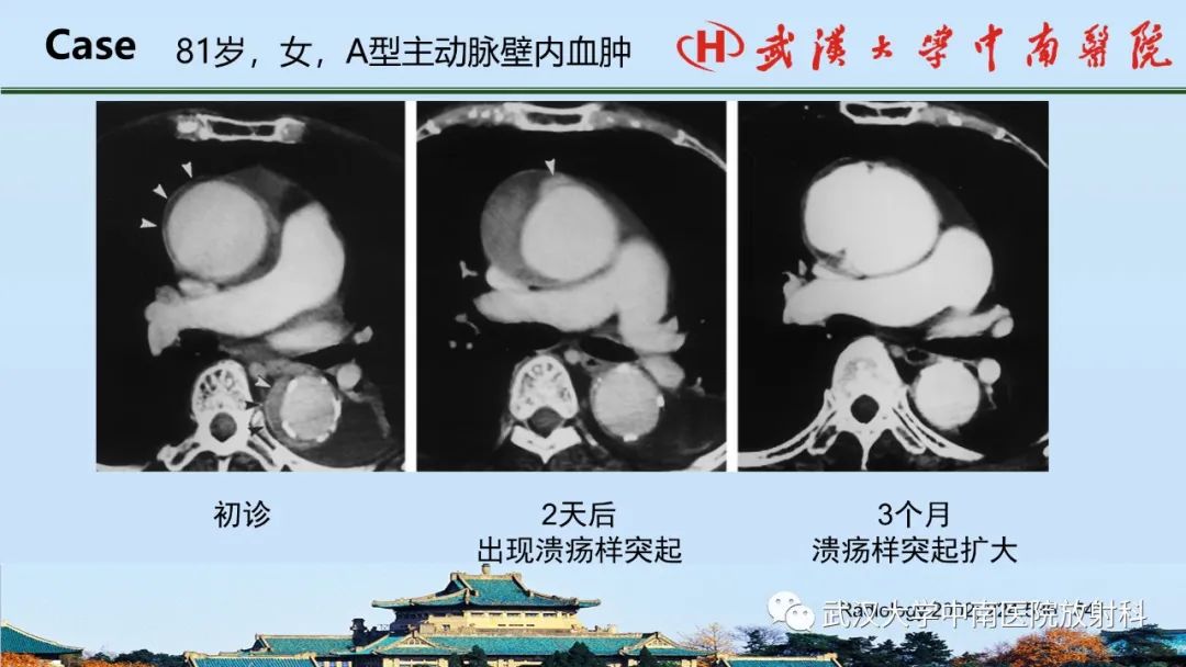 影像PPT - 【PPT】主动脉壁内血肿和穿透性溃疡的影像学诊断-21
