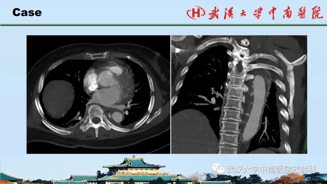 影像PPT - 【PPT】主动脉壁内血肿和穿透性溃疡的影像学诊断-24