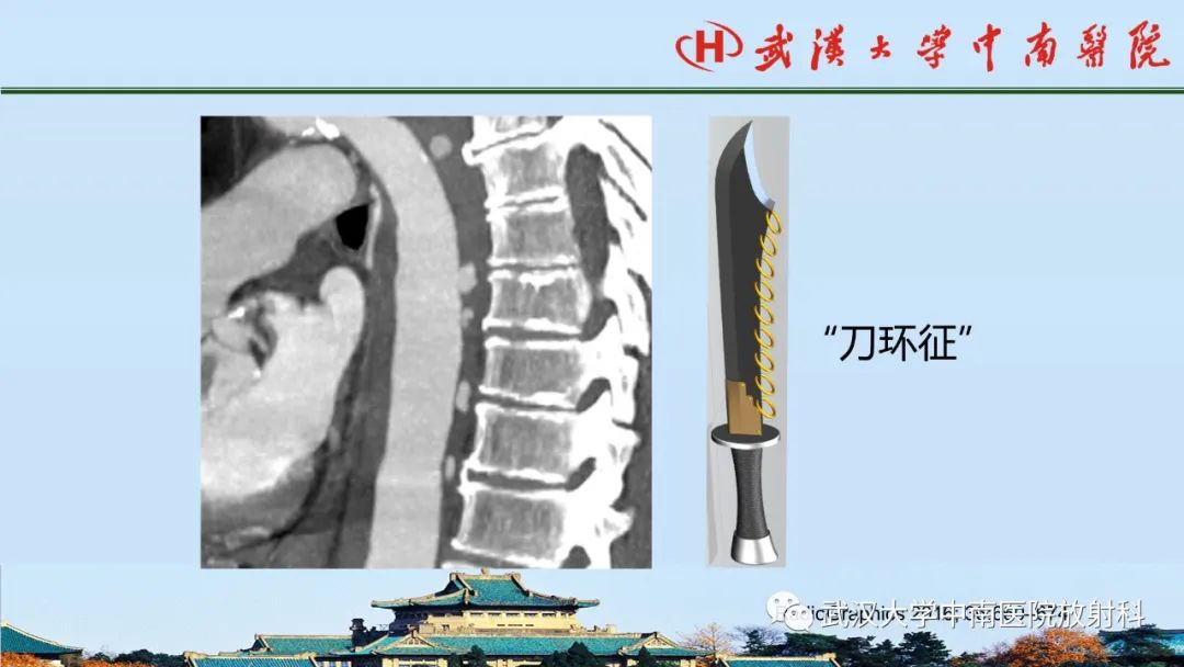 影像PPT - 【PPT】主动脉壁内血肿和穿透性溃疡的影像学诊断-25