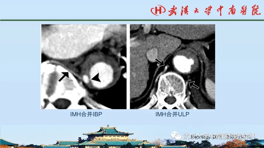 影像PPT - 【PPT】主动脉壁内血肿和穿透性溃疡的影像学诊断-26