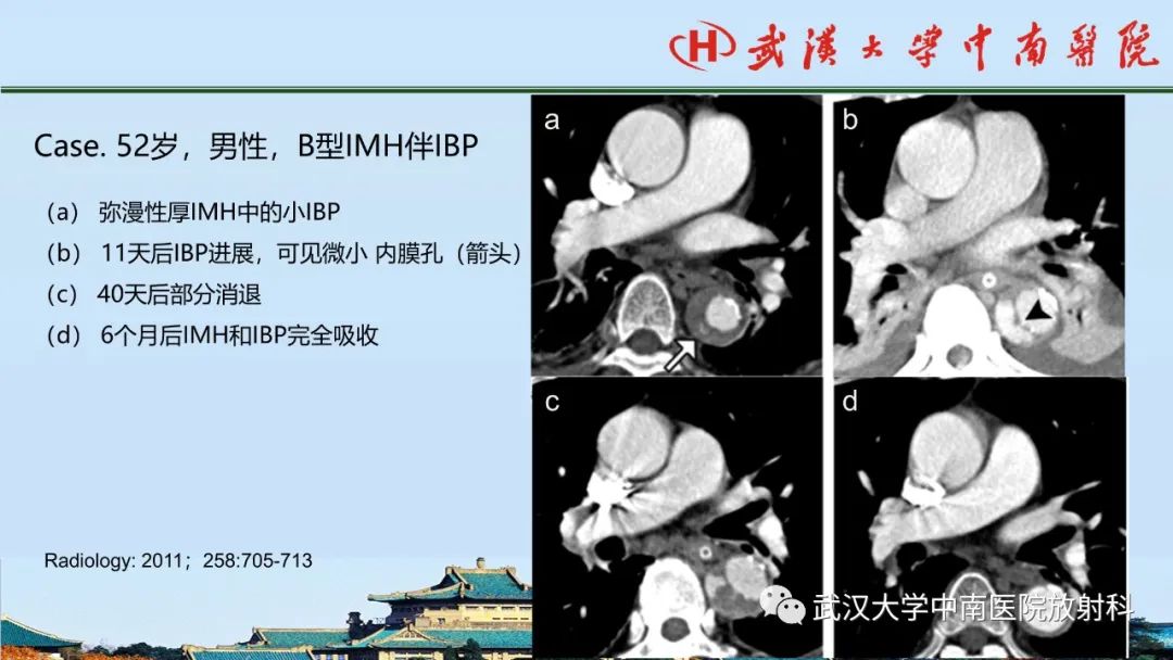 影像PPT - 【PPT】主动脉壁内血肿和穿透性溃疡的影像学诊断-28