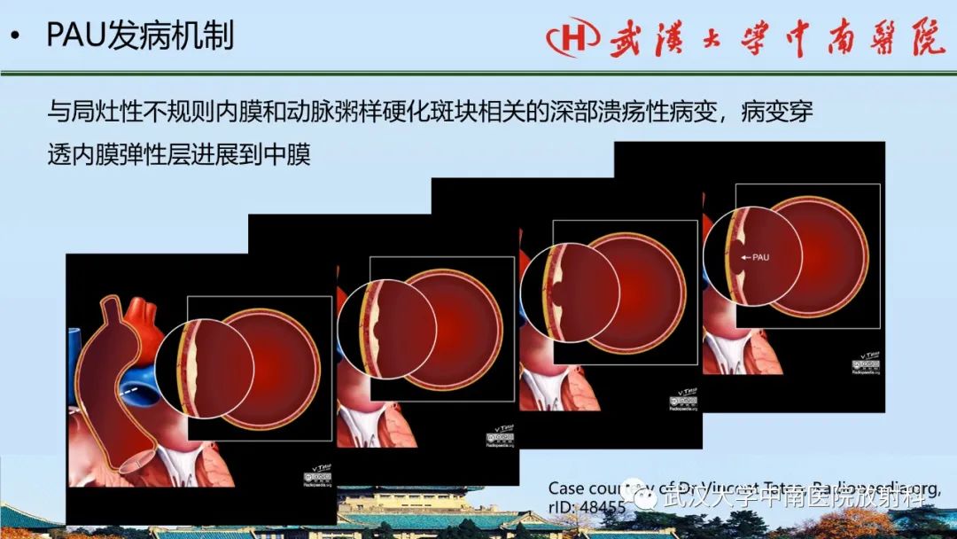影像PPT - 【PPT】主动脉壁内血肿和穿透性溃疡的影像学诊断-32