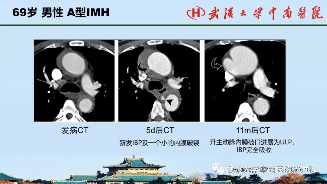 影像PPT - 【PPT】主动脉壁内血肿和穿透性溃疡的影像学诊断-27
