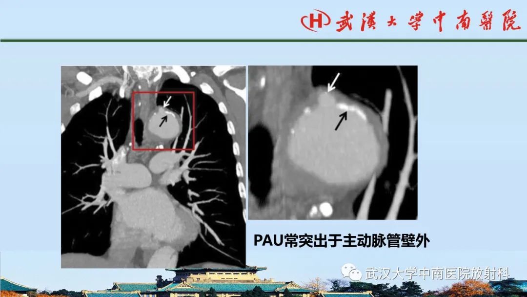 影像PPT - 【PPT】主动脉壁内血肿和穿透性溃疡的影像学诊断-34