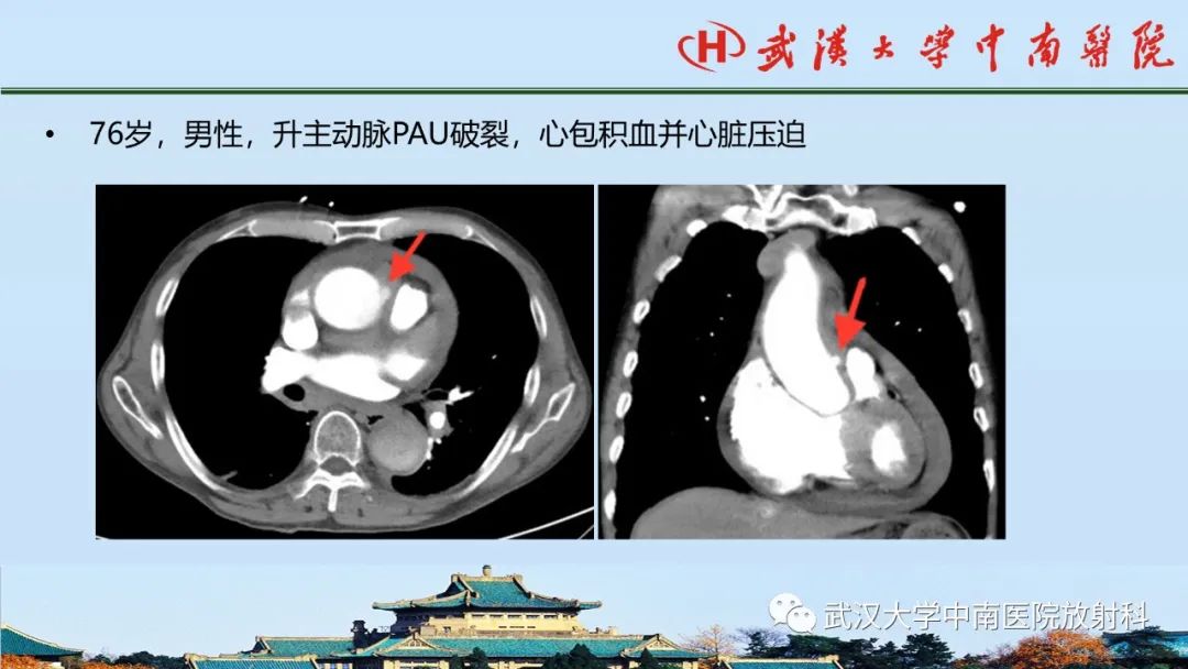 影像PPT - 【PPT】主动脉壁内血肿和穿透性溃疡的影像学诊断-35