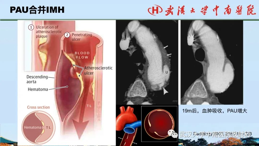 影像PPT - 【PPT】主动脉壁内血肿和穿透性溃疡的影像学诊断-36