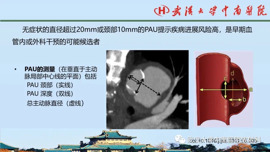 影像PPT - 【PPT】主动脉壁内血肿和穿透性溃疡的影像学诊断-38