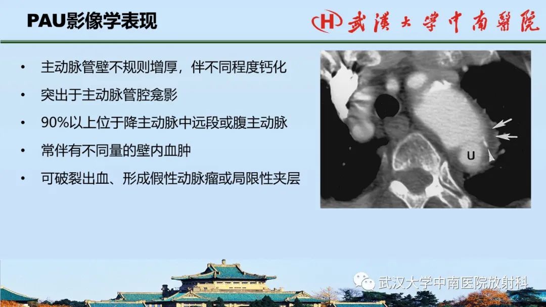 影像PPT - 【PPT】主动脉壁内血肿和穿透性溃疡的影像学诊断-33