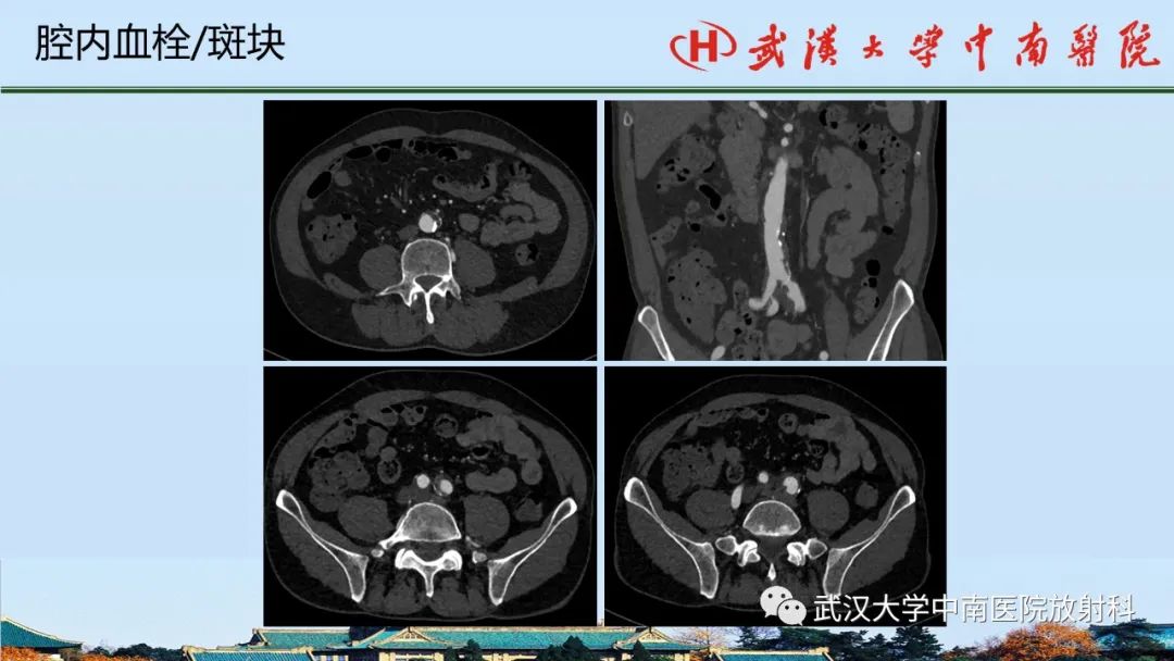 影像PPT - 【PPT】主动脉壁内血肿和穿透性溃疡的影像学诊断-43