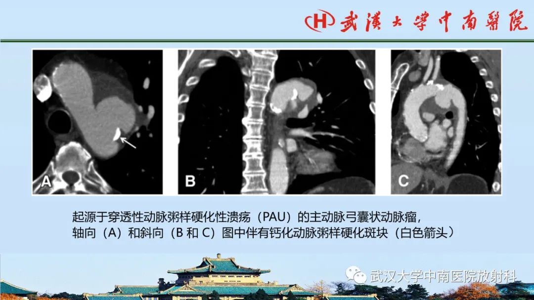 影像PPT - 【PPT】主动脉壁内血肿和穿透性溃疡的影像学诊断-37