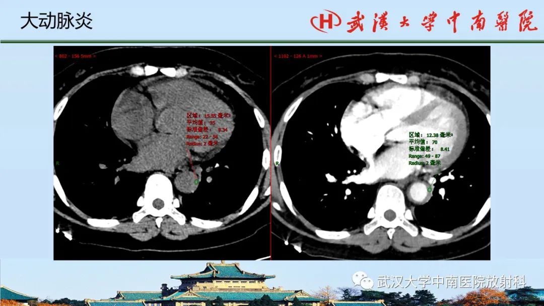 影像PPT - 【PPT】主动脉壁内血肿和穿透性溃疡的影像学诊断-44